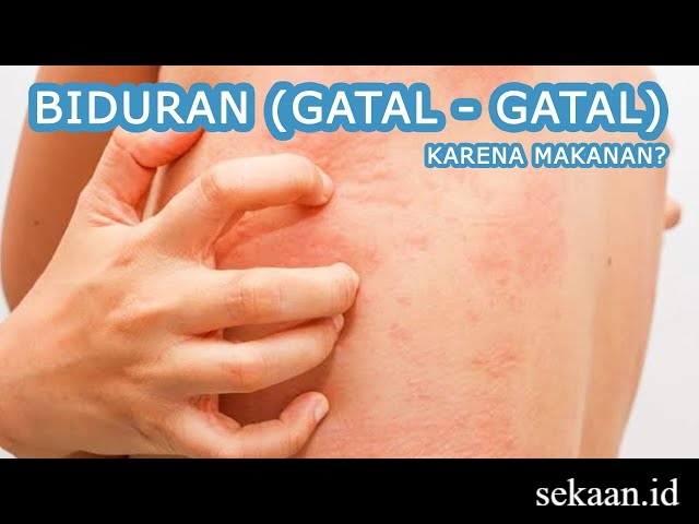 Cara Mengatasi Dan Penyebab Kulit Tiba - Tiba Gatal Dan Bentol